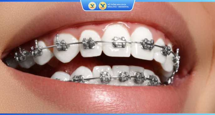 Bảng giá dịch vụ chỉnh nha, niềng răng thẩm mỹ
